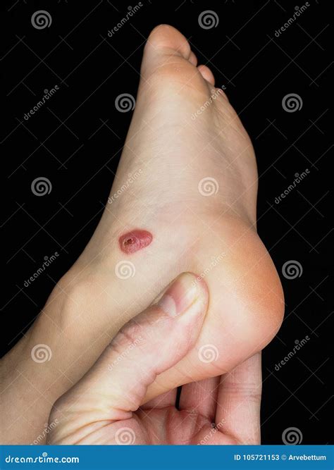Blood blister below ankle stock image. Image of fluid - 105721153