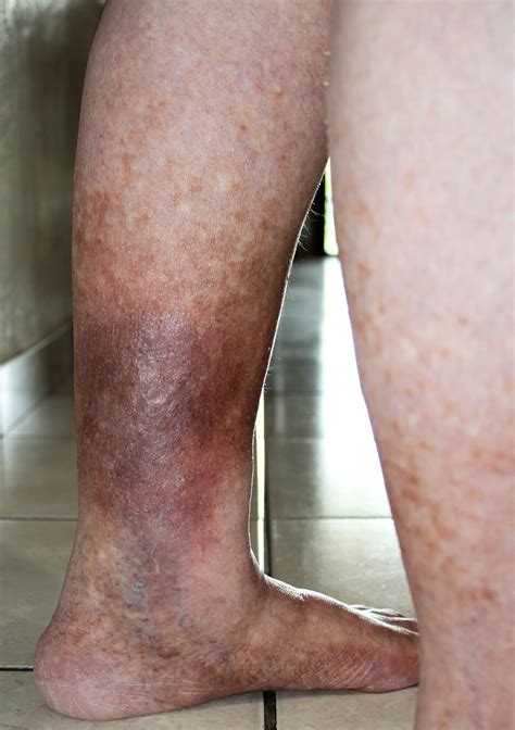 Venous Insufficiency Treatment | Irvine, CA | Laguna Woods, CA