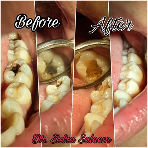 How to fix cavities in teeth | Dr.Sidra Saleem posted on the topic | LinkedIn