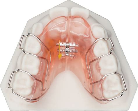 Upper Expander - Protec Dental