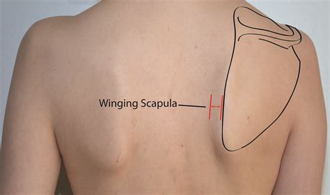What is winged scapula and how to fix it | TFA (Training for Acro)