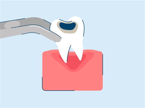 Tooth Extraction: Procedure, Aftercare, and Recovery