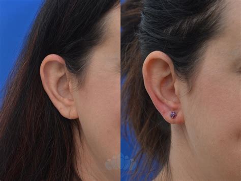 Earlobe Repair Before and After Pictures Case 52 | Charlotte, NC | Dilworth Facial Plastic Surgery