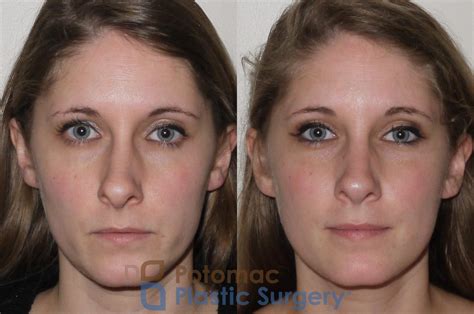 Septoplasty And Turbinate Reduction