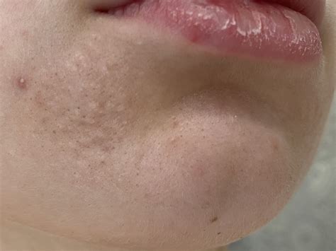 Bumps on chin (sebaceous hyperplasia?) – Acne – Acne.org Forum