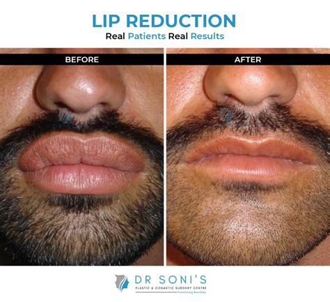 Lip Reduction Surgery