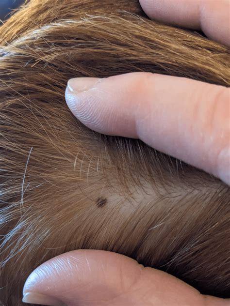 Melanoma Scalp