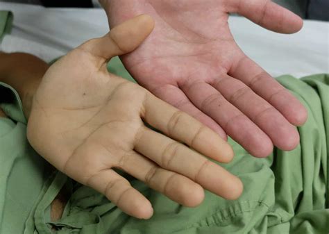 ¿Qué es la hepatitis y cómo se puede tratar?