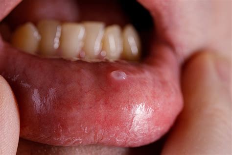 Oral Mucocele (Oral Cysts) | Oral & Facial Health | Welbeck