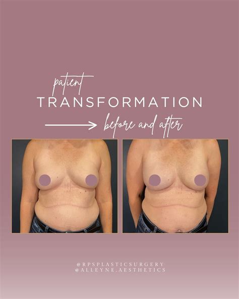 Breast Reconstruction Transformation Before & After with @alleyne.aesthetics! This beautiful ...