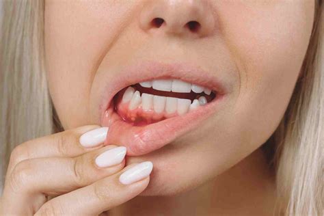 How to Get Rid of a Gum Boil?