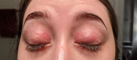 Periocular Dermatitis Around Eyes