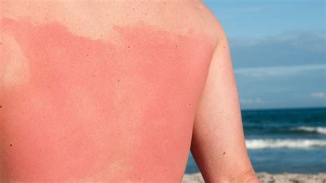 You'll Never Skip Sunscreen Again After Seeing This Scary Viral Sunburn ...