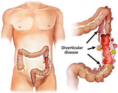 Sigmoid colon anatomy, location, function, polyps, diverticulosis & cancer