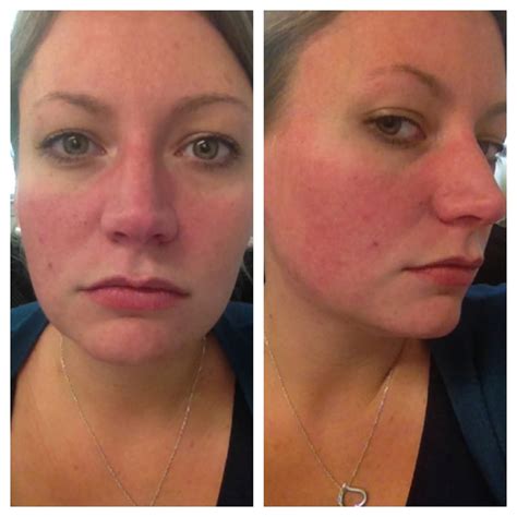 Face Flushing Only At Night at William Noland blog