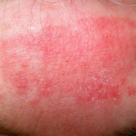 Study Shows How Eczema is Genetic | Cosmetics & Toiletries