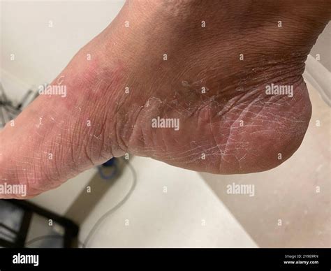 Moccasin type athlete's foot. Athlete's foot, or tinea pedis, is a form ...