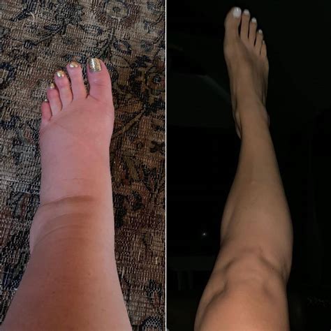 Jessica Simpson's Postpartum Ankle Pic After Swollen Pregnancy Feet ...