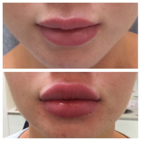 Types Of Injectable Lip Fillers at Will Cornish blog