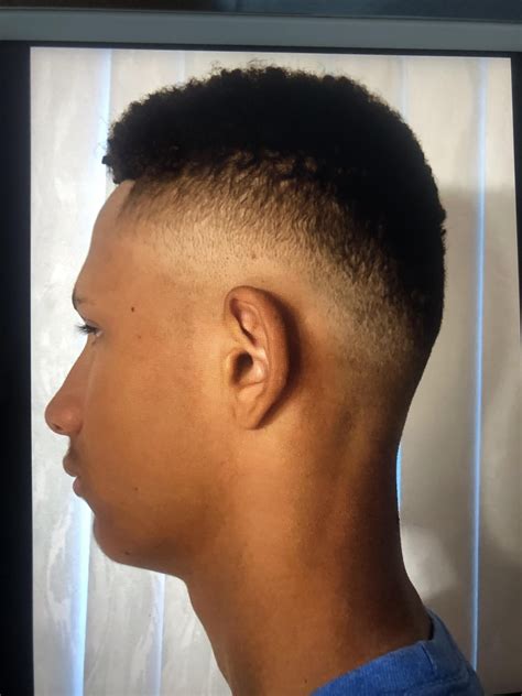 15 and recessed/ugly w/ upper eyelid exposure ——> 18 and still ugly but ...