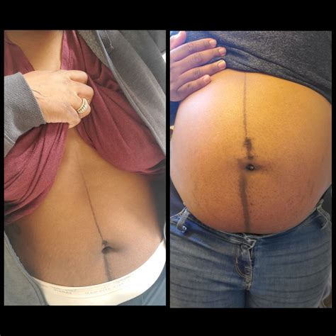 Linea Nigra Postpartum