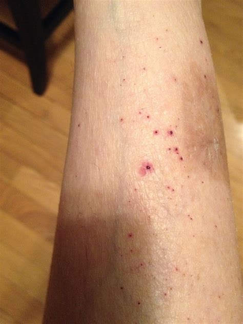 Busted Blood Vessel In Leg