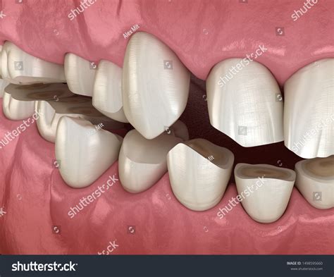 325 Attrition Tooth Images, Stock Photos & Vectors | Shutterstock