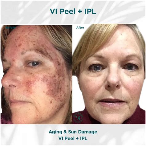 Chemical Peels - White Plains, MD: Charles County Dermatology Associates: Dermatologist