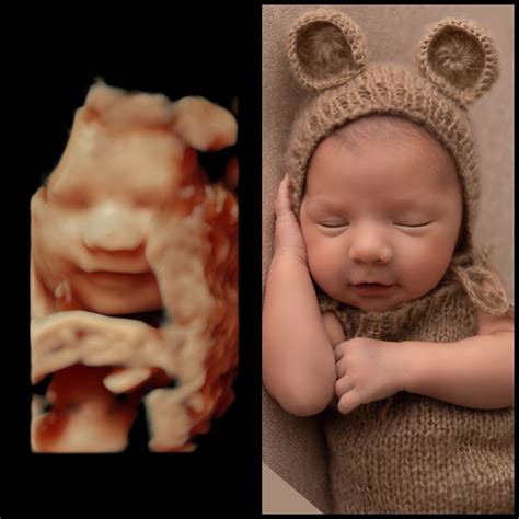 What is 4D Ultrasound?