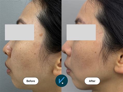 Laser mole removal | Spot Check Clinic - skin cancer & aesthetics