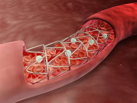 Stents: Types, Uses, Side Effects, and Risks