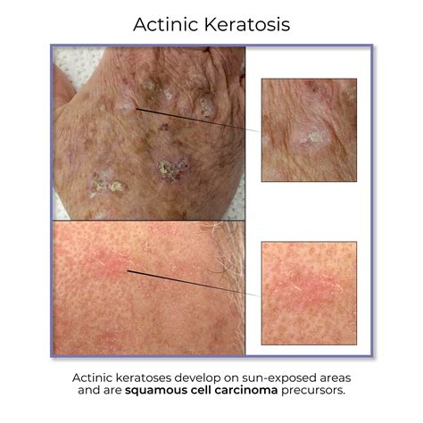 Actinic Keratosis Pathology