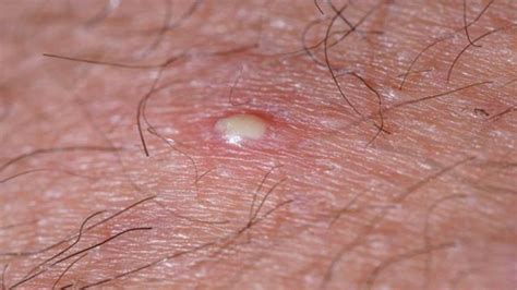 جوش دردناک ناحیه تناسلی را چگونه التیام ببخشیم؟ - کلینیک زنان و زایمان ...