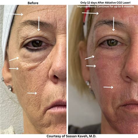 CO2 Laser Resurfacing Around Eyes: The Best Non-Surgical Fix for Fine Lines and Eye Bags