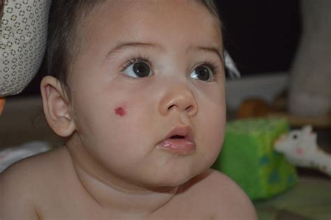 Strawberry Birthmark Definition at Will Hannah blog