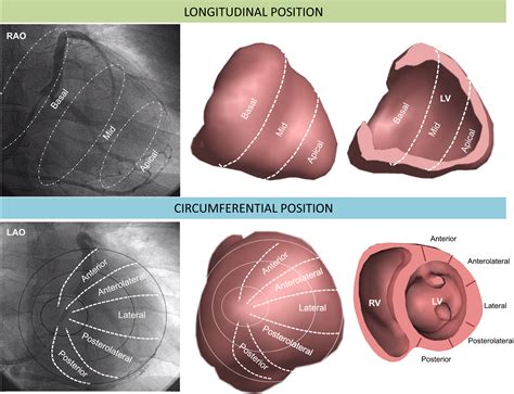 Long‐Term Outcomes of Cardiac Resynchronization Therapy Using Apical ...