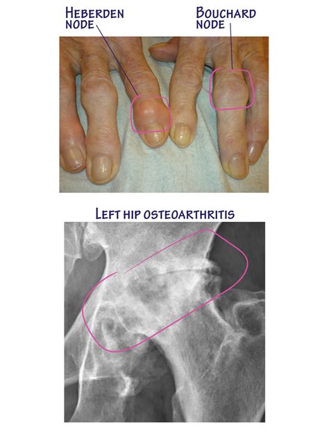 Clinical Pathology Glossary: Osteoarthritis | ditki medical ...