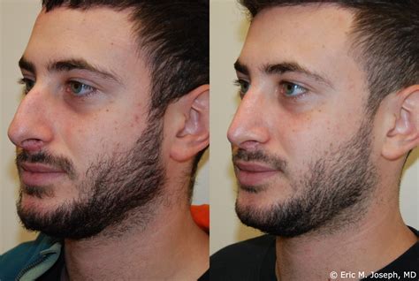 Eric M. Joseph, MD | 25-Year-Old Male Rhinoplasty Before and After Photos New Jersey