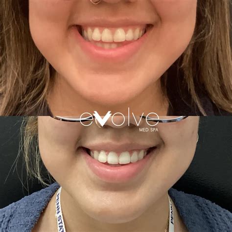 Botox Lip Flip Results | Evolve Med Spa