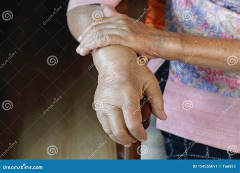Elderly Swollen Hand or Edema Hand Stock Image - Image of fingers, close: 154555691