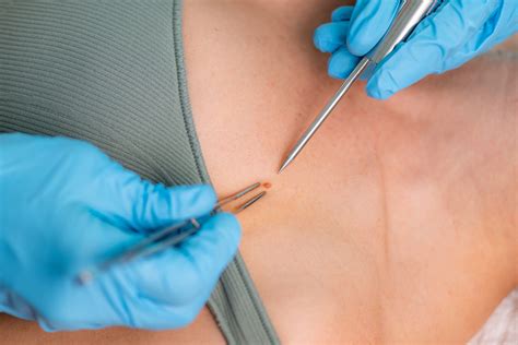 An In-Depth Patient's Guide To Punch Biopsy - The Skin Drs.