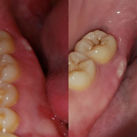 Bone Sticking Out Inside Mouth at Marie Renda blog