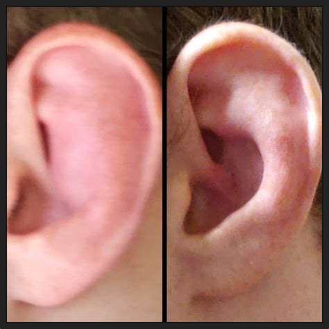 Cauliflower Ear Before And After