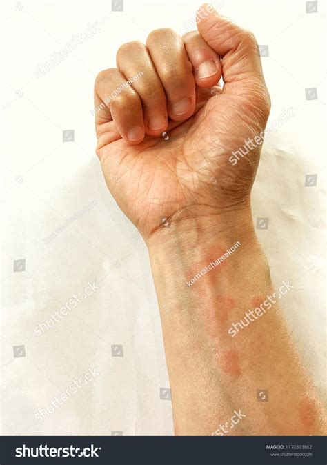 202 Red Lupus Patient Images, Stock Photos & Vectors | Shutterstock
