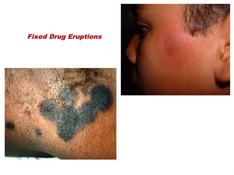 Drug eruptions | PPT