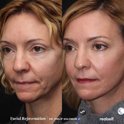 Facelift procedure – Artofit