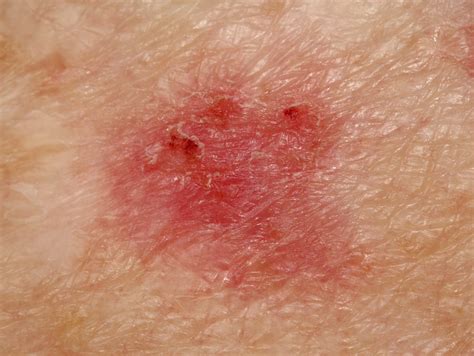 Basal Cell Carcinoma Stages Pictures at Gayla Wilson blog