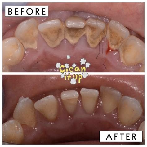 Teeth Deep Cleaning Before And After