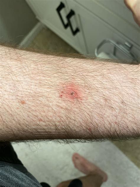 Brown Recluse Spider Bite First Stage
