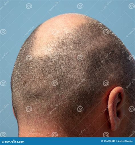 Bald Patch on a Man S Head Against a Sky. Stock Photo - Image of neck, concept: 256010048